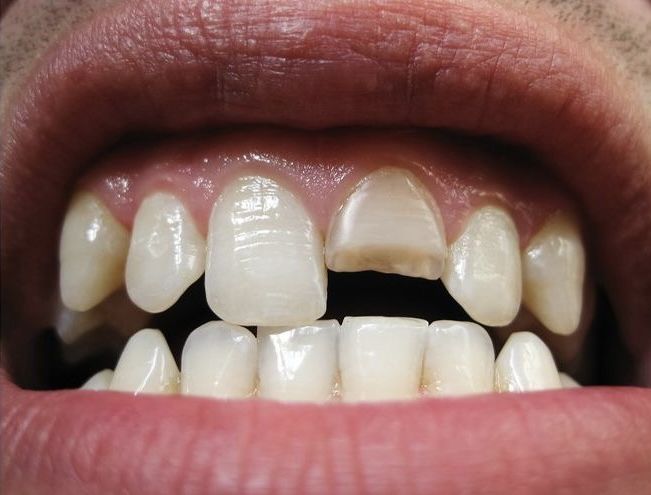 Tooth shape concerns before veneer treatment